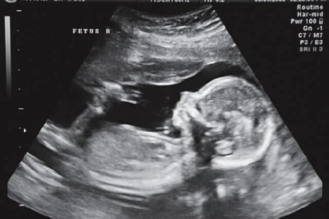 La Casa Blanca tacha de "peligrosa" la medida que prohibiría el aborto a partir de la sexta semana en Florida