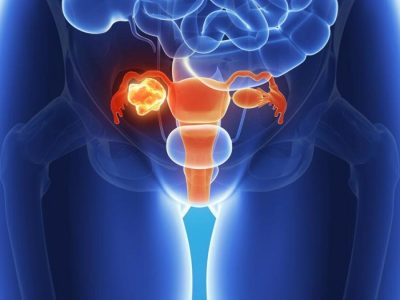 Día Mundial del Cáncer de Ovario: Un tumor sigiloso que afecta a más mujeres