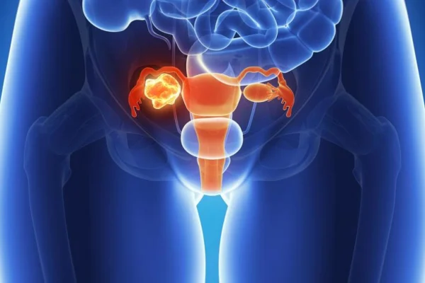 Día Mundial del Cáncer de Ovario: Un tumor sigiloso que afecta a más mujeres