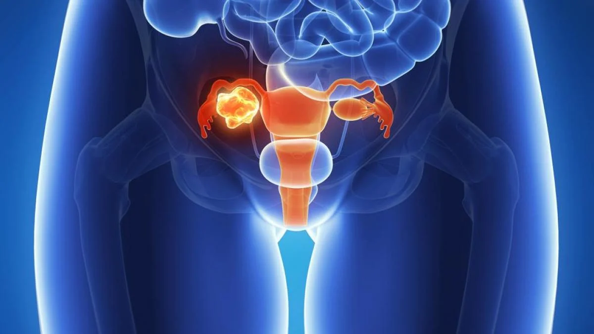 Día Mundial del Cáncer de Ovario: Un tumor sigiloso que afecta a más mujeres