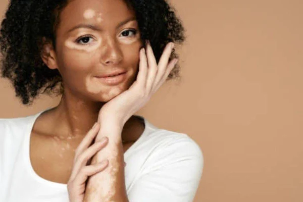 Vitiligo