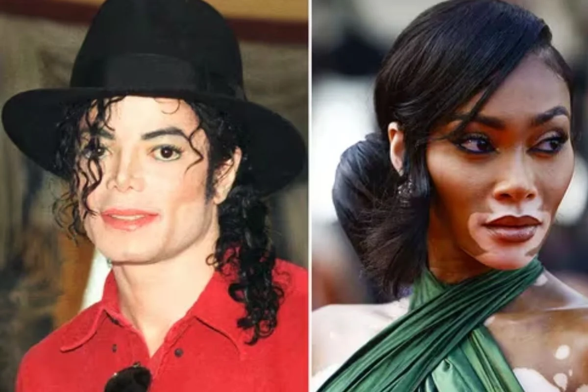 Vitiligo