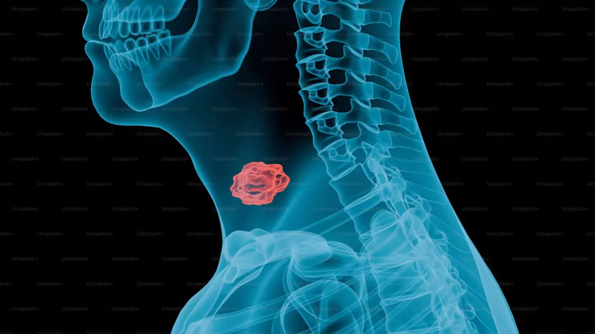 Salud Pública resalta la importancia del diagnóstico oportuno y adecuado del cáncer de tiroides